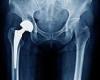 Sunday 26 June 2022 02:12 AM Gene test could tell if your hip surgery will fail trends now