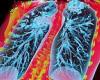Sunday 3 July 2022 12:06 AM Lung disease sufferers may be offered first ever treatment thanks to daily pill trends now