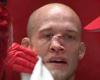sport news GRAPHIC CONTENT WARNING: Mixed martial artist gets the worst broken nose you ... trends now