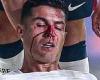 sport news Man United star Cristiano Ronaldo suffers HORROR injury in Portugal's thrashing ... trends now