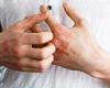 Tuesday 27 September 2022 01:29 AM How can I get rid of rash on my hands? DR MARTIN SCURR answers your health ... trends now
