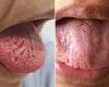 Thursday 29 September 2022 06:44 PM Woman, 60, suffers agonizing TONGUE ulcers after getting Pfizer COVID vaccine trends now