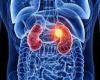 Wednesday 23 November 2022 04:08 PM Hope for thousands battling kidney cancer: Study reveals existing lung drug ... trends now