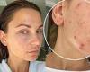 Friday 25 November 2022 05:02 PM Sam Faiers shares her battle with cystic acne in comparison snap trends now