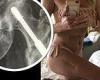 Sharron Davies, 60, shares previously unseen x-ray three years after breaking ... trends now