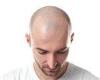 Male pattern baldness affects two-thirds of men but treatments on the horizon trends now
