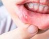 What are the best ways to ease pain of mouth ulcers? DR MARTIN SCURR answers ... trends now