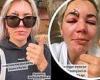 A Place In The Sun's Danni Menzies reveals her graphic facial injuries trends now