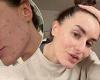 Amber Davies opens up on her 'mid-20's skin crisis' as she admits suffering ... trends now