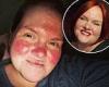 My rosacea was so bad I was branded 'a tomato' and endured cosmetic surgery ... trends now