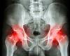 Is 93 is too old to get a new hip? DR MARTIN SCURR answers your health ... trends now