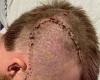 sport news NBL player Harry Froling shares photo of surgical scar after coward punch attack trends now