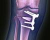 Arthritis experts call for 10k NHS patients to be offered knee operation to ... trends now