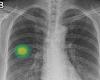 AI X-ray screening tool is twice as effective at discovering lung cancer as ... trends now