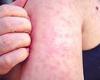US suffers years' worth of measles cases already in first two months of 2024 - ... trends now
