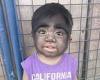 Mother feared her son's 'werewolf syndrome' condition was caused by eating a ... trends now