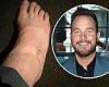 Chris Pratt reveals he injured his ankle on just the fourth day of filming his ... trends now