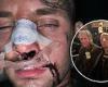 sport news AEW star Darby Allin shares gruesome snap of busted-up face after he was hit by ... trends now