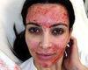 Brits warned Kim Kardashian-inspired 'vampire facials' at unregulated clinics ... trends now