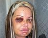 Mother-of-three shares images of her horrific facial injuries after she was ... trends now