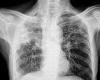 Tuberculosis outbreak: At least one dead, nine hospitalized, as health ... trends now