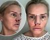 Kerry Katona reveals the gruesome results of her nose job after going under the ... trends now