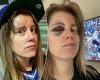 sport news Blue Jays fan is left with a gruesome bump on her head and a black eye after ... trends now